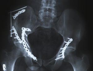 Hip Fractures and Other Fall Injuries and Neglect - New Prague Nursing Home Abuse Lawyers Kenneth LaBore and Suzanne Scheller