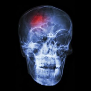 Head Injury After Client Falls - Winona Nursing Home Abuse Lawyers Kenneth LaBore and Suzanne Scheller