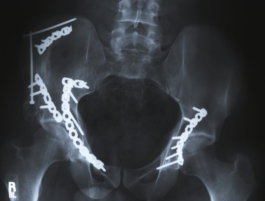 a fractured hip