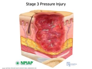 NPUAP Stage 3 Pressure Injury, Most Pressure Ulcer Injury is Preventable With Proper Care and Pressure Relief